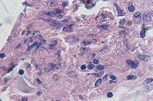 Ziehl-Neelsen -osoitusvärjäyskitti