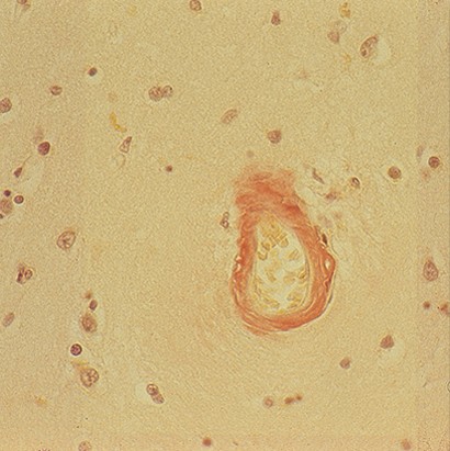 Congo Red -osoitusvärjäyskitti
